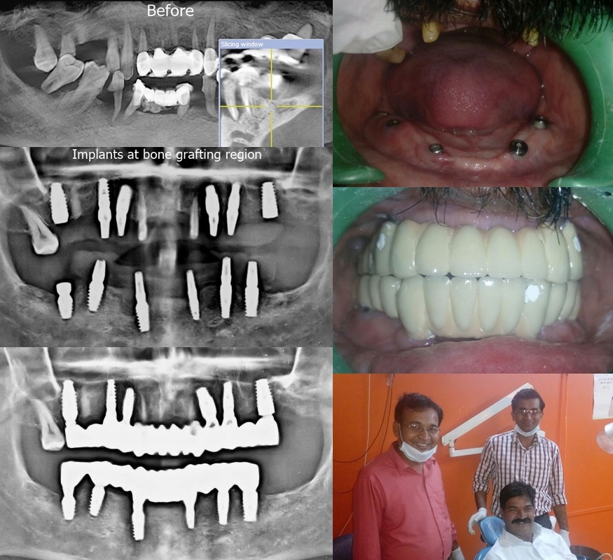 Full Mouth Dental Implant In Advanced Generalized Periodontitis